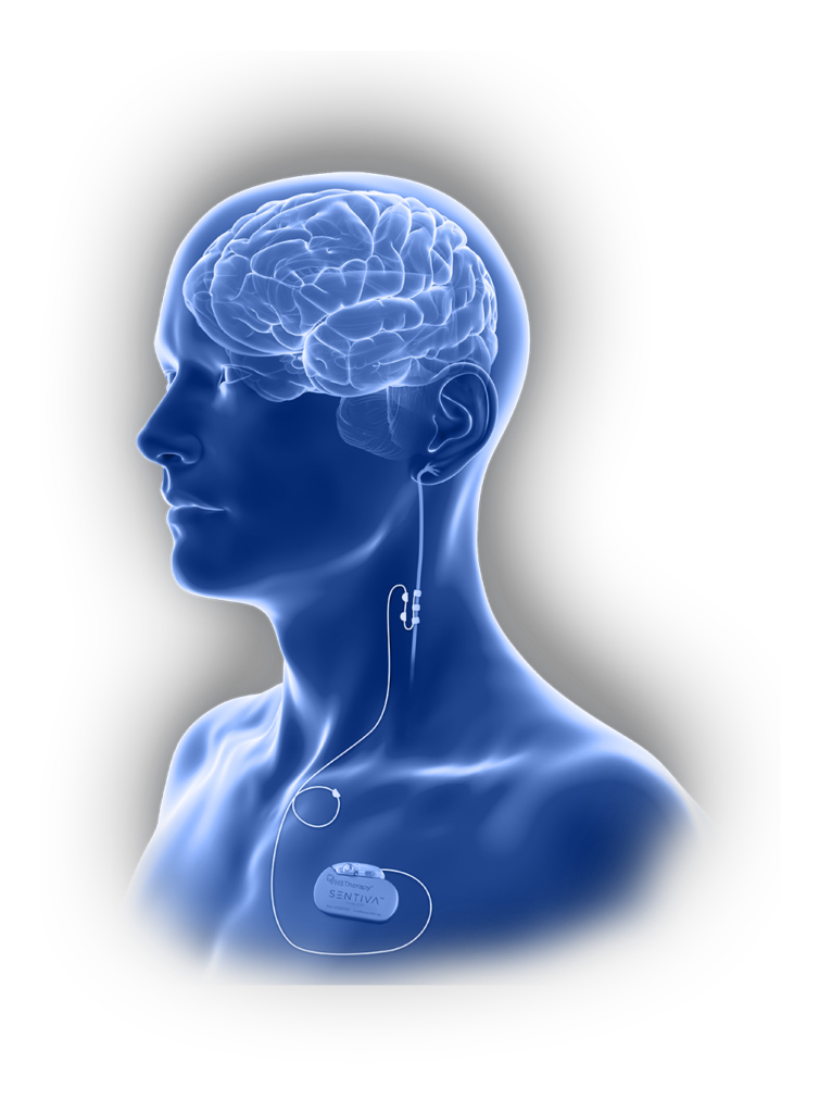LivaNova SenTiva VNS Therapy